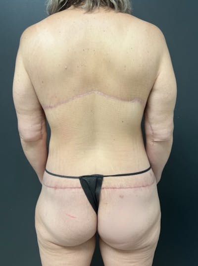 Back Lift Before & After Gallery - Patient 324257 - Image 2