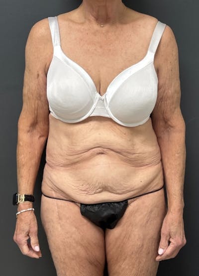 Tummy Tuck Before & After Gallery - Patient 208920 - Image 1