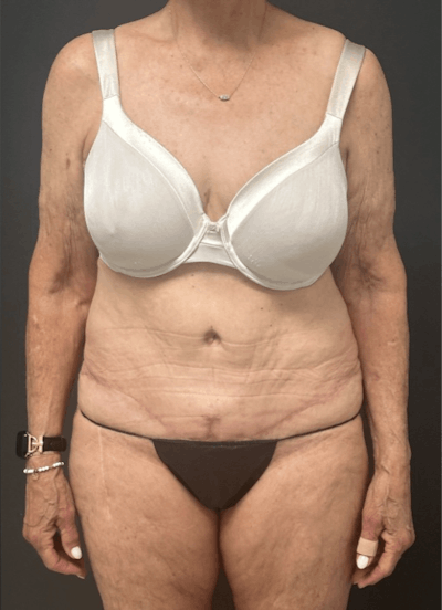 Tummy Tuck Before & After Gallery - Patient 208920 - Image 2