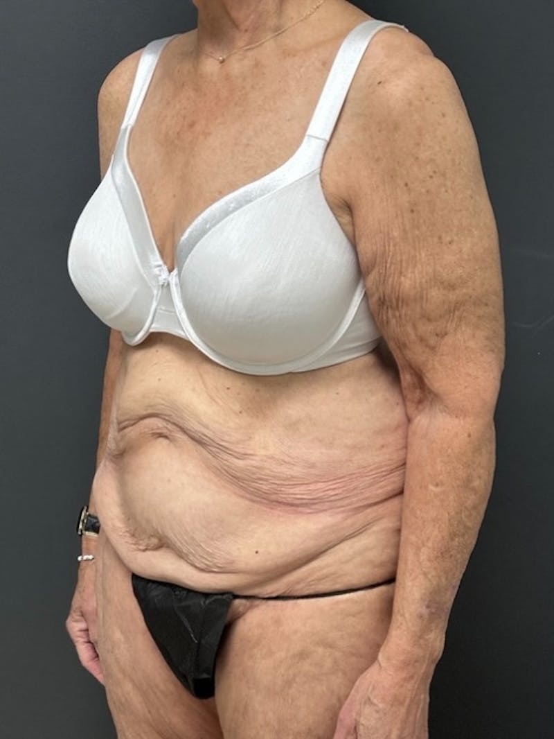 Abdominoplasty (Tummy Tuck) Before & After Gallery - Patient 208920 - Image 3