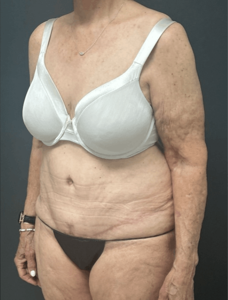 Abdominoplasty (Tummy Tuck) Before & After Gallery - Patient 208920 - Image 4