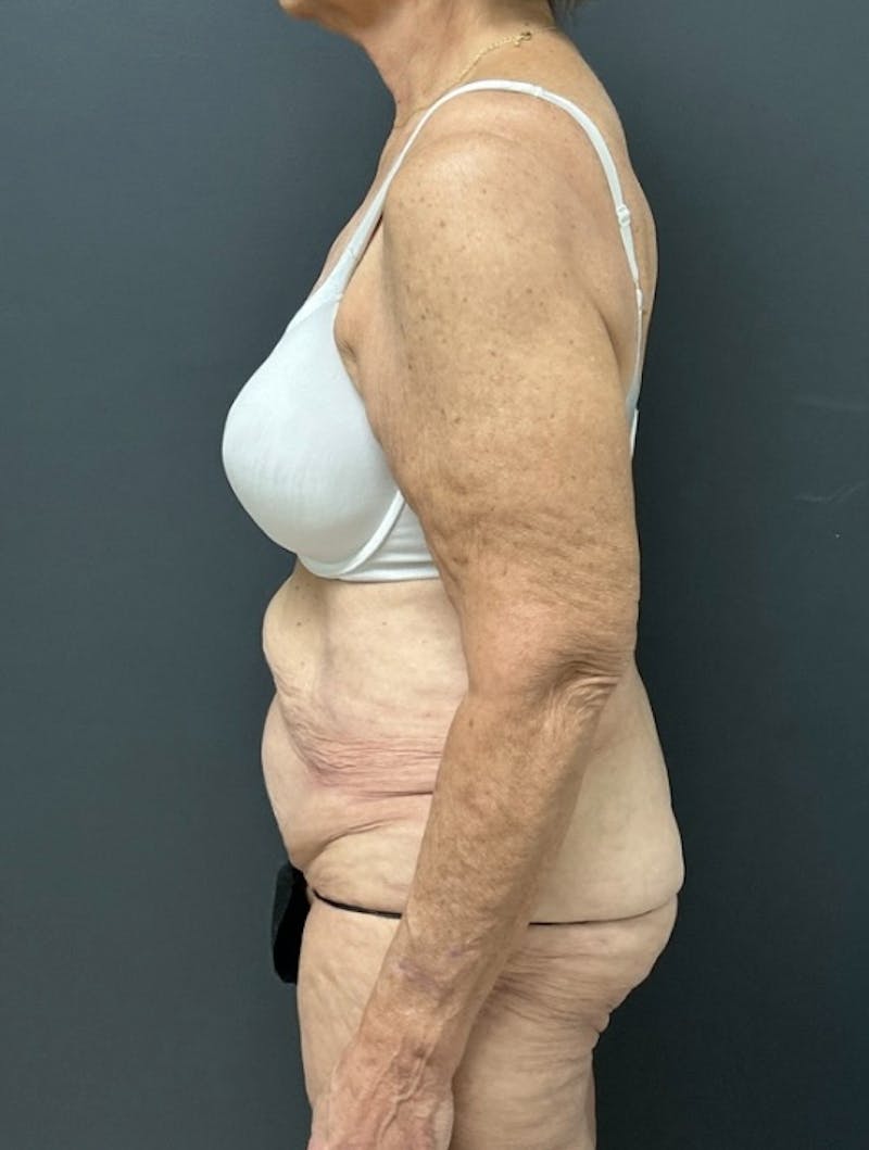 Abdominoplasty (Tummy Tuck) Before & After Gallery - Patient 208920 - Image 5