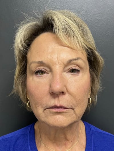 Facelift Before & After Gallery - Patient 832821 - Image 1