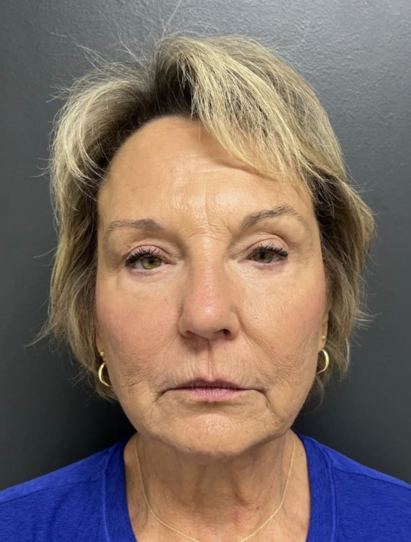 Facelift Before & After Gallery - Patient 832821 - Image 1