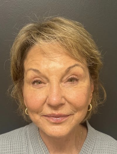 Facelift Before & After Gallery - Patient 832821 - Image 2