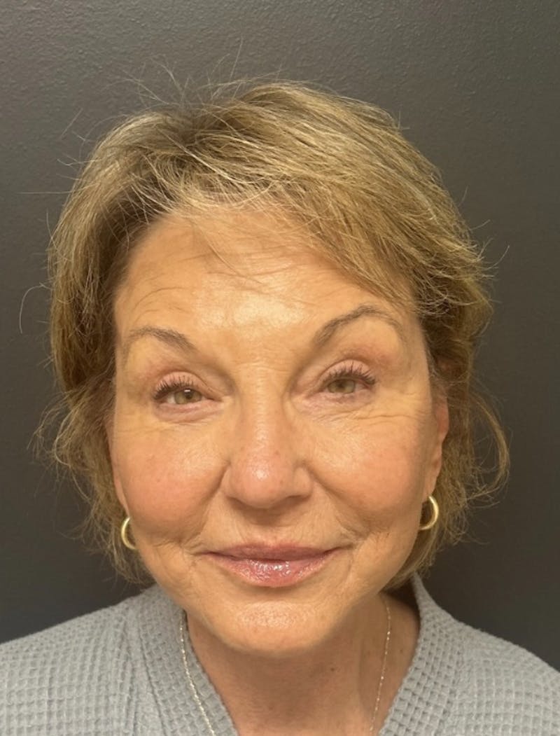 Facelift Before & After Gallery - Patient 832821 - Image 2