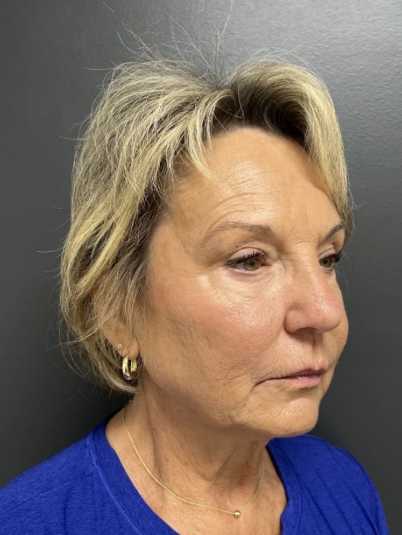 Facelift Before & After Gallery - Patient 832821 - Image 3