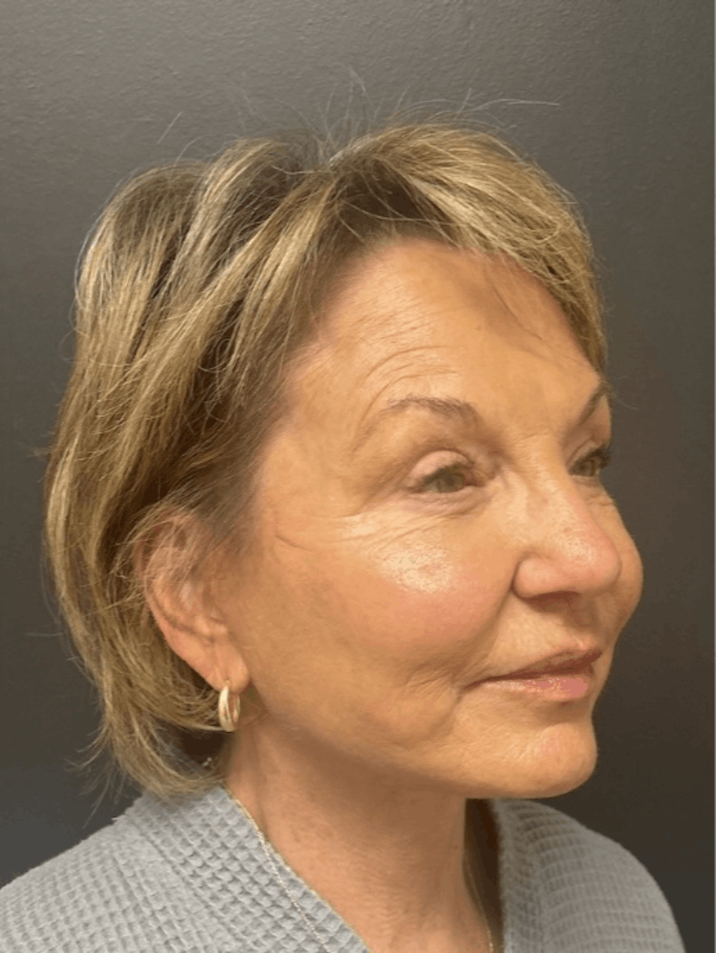 Facelift Before & After Gallery - Patient 832821 - Image 4