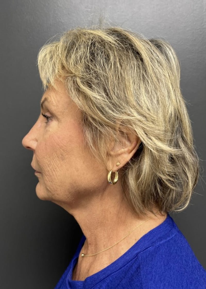 Facelift Before & After Gallery - Patient 832821 - Image 5