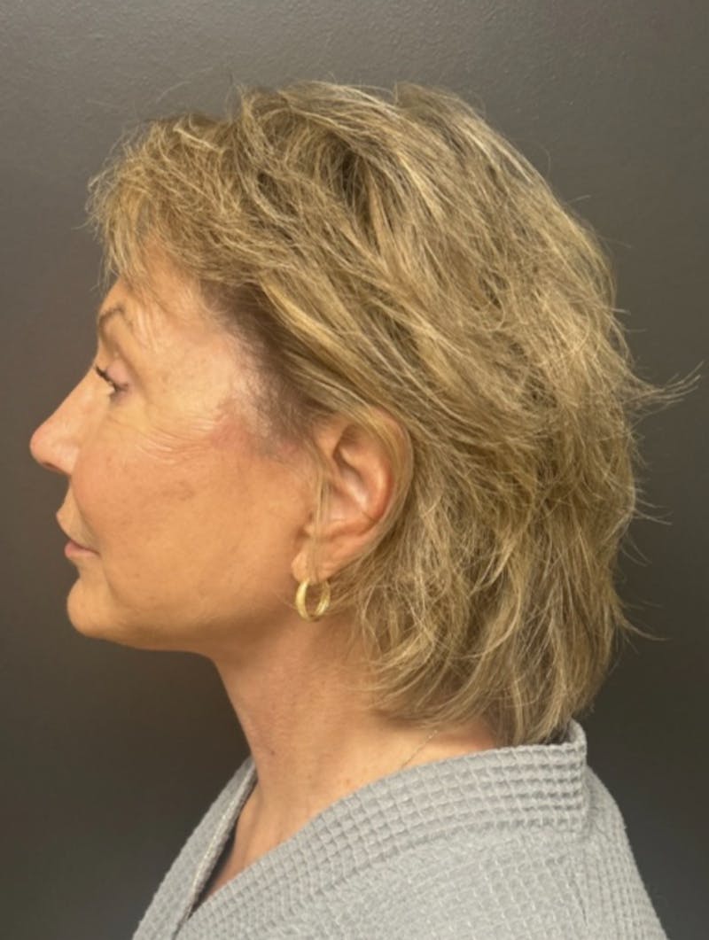 Facelift Before & After Gallery - Patient 832821 - Image 6