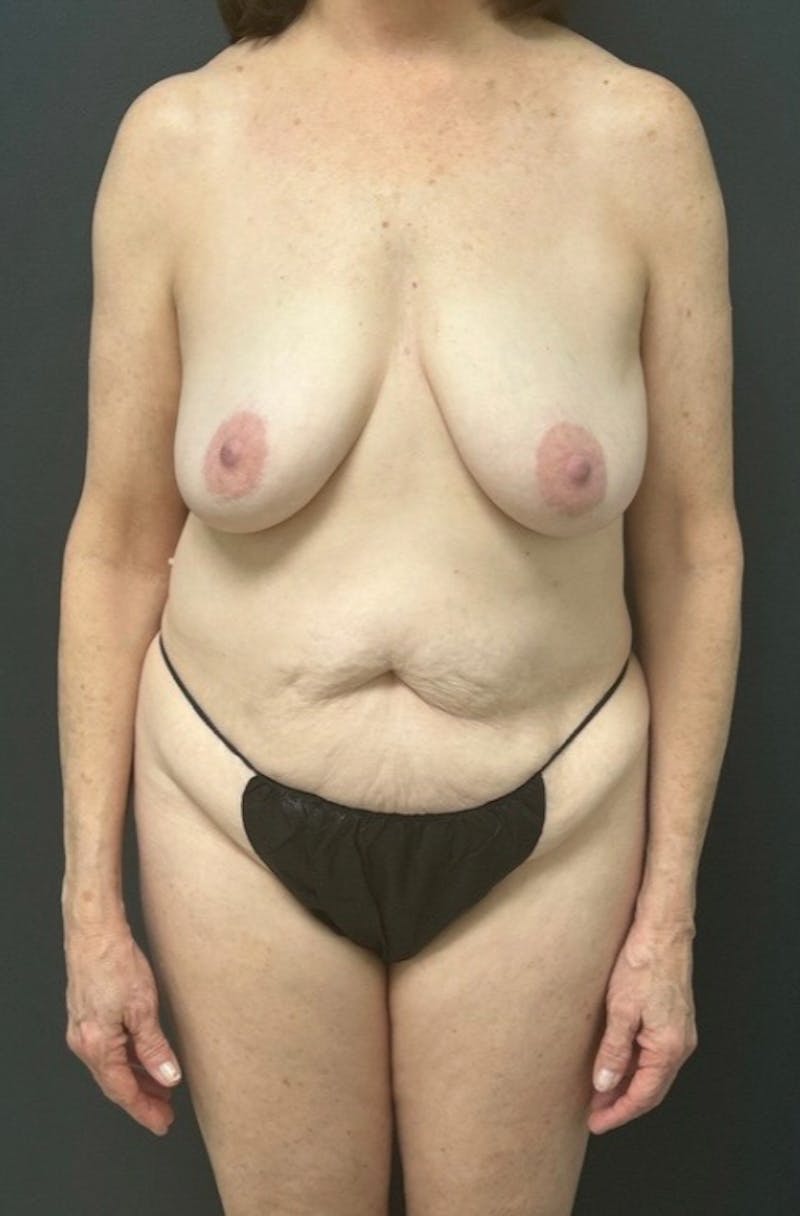 Abdominoplasty (Tummy Tuck) Before & After Gallery - Patient 416791 - Image 1