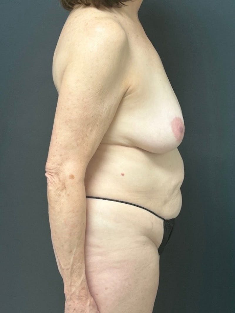 Abdominoplasty (Tummy Tuck) Before & After Gallery - Patient 416791 - Image 3
