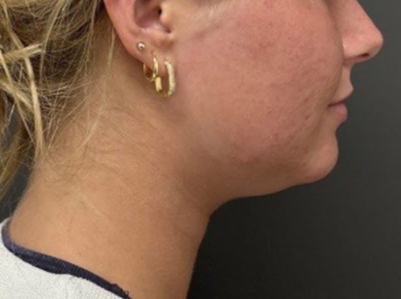 Submental Liposuction Before & After Gallery - Patient 772103 - Image 3