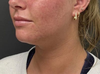 Submental Liposuction Before & After Gallery - Patient 772103 - Image 1