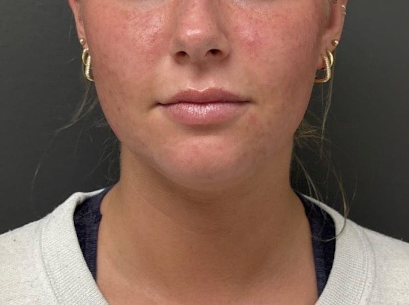 Submental Liposuction Before & After Gallery - Patient 772103 - Image 5