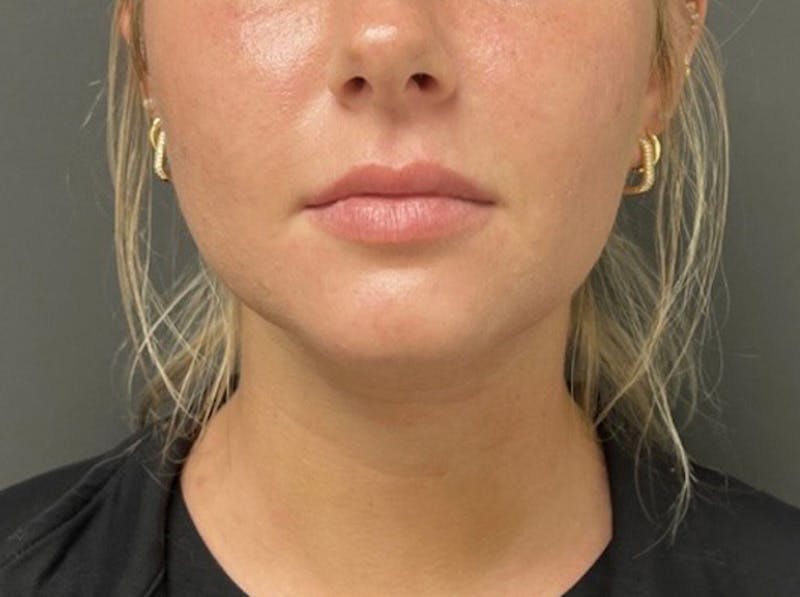 Submental Liposuction Before & After Gallery - Patient 772103 - Image 6