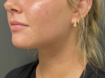 Submental Liposuction Before & After Gallery - Patient 772103 - Image 2