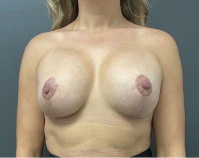 Breast Augmentation with Lift Before & After Gallery - Patient 188273 - Image 2