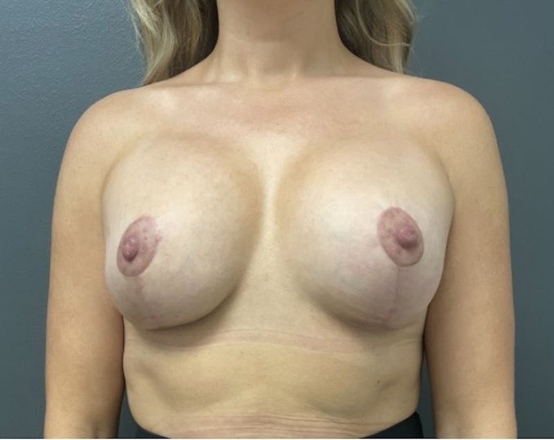 Breast Augmentation with Lift Before & After Gallery - Patient 188273 - Image 2