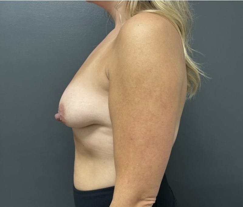 Breast Augmentation with Lift Before & After Gallery - Patient 188273 - Image 5