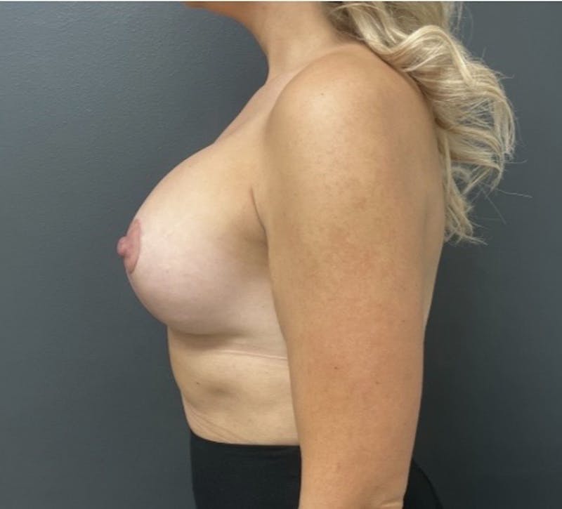 Breast Augmentation with Lift Before & After Gallery - Patient 188273 - Image 6