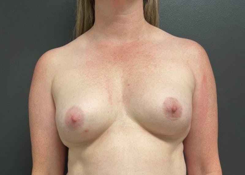 Breast Fat Grafting Before & After Gallery - Patient 365284 - Image 1