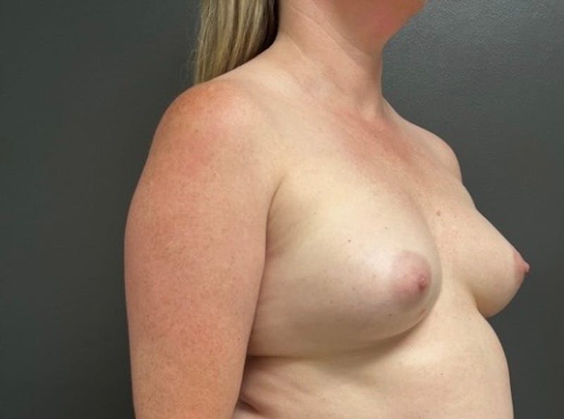 Breast Fat Grafting Before & After Gallery - Patient 365284 - Image 3