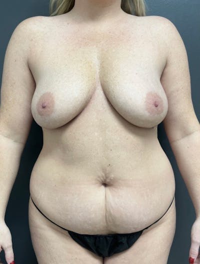 Mini Abdominoplasty Before & After Gallery - Patient 423195 - Image 1