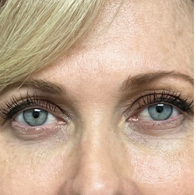 Blepharoplasty Before & After Gallery - Patient 427325 - Image 1