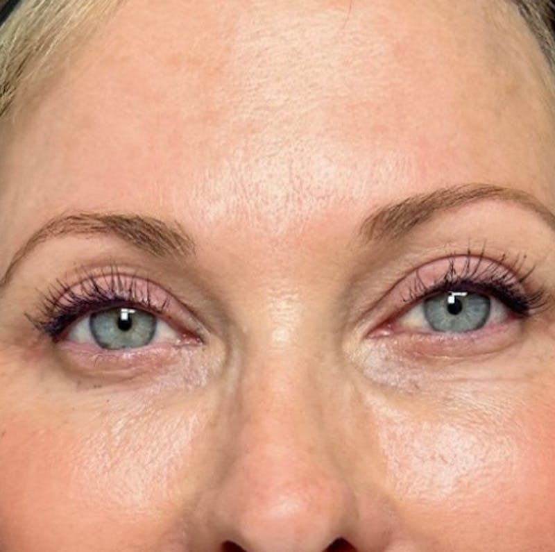 Blepharoplasty Before & After Gallery - Patient 427325 - Image 2