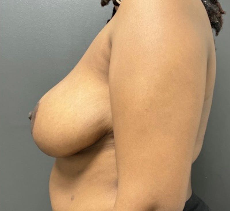 Breast Reduction Before & After Gallery - Patient 404392 - Image 6
