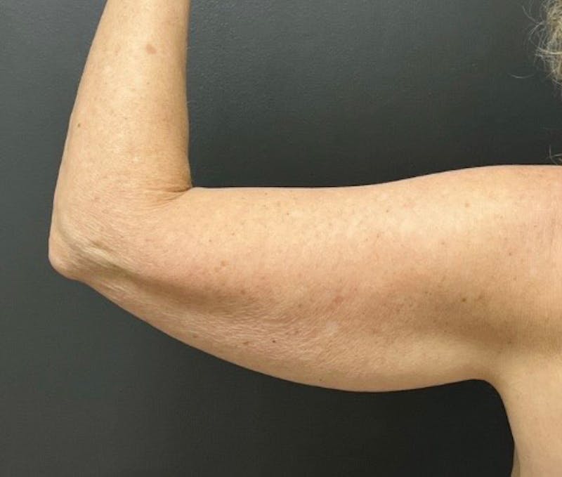 Brachioplasty (Arm Lift) Before & After Gallery - Patient 588043 - Image 5