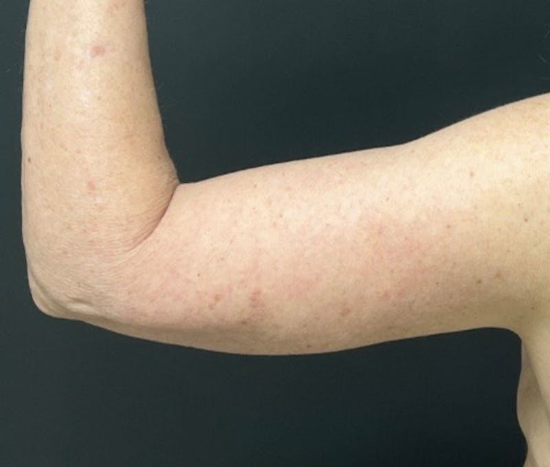 Brachioplasty (Arm Lift) Before & After Gallery - Patient 588043 - Image 6