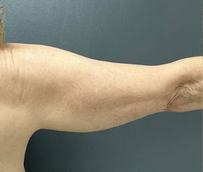 Arm Lift Before & After Gallery - Patient 588043 - Image 1