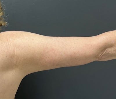 Arm Lift Before & After Gallery - Patient 588043 - Image 2