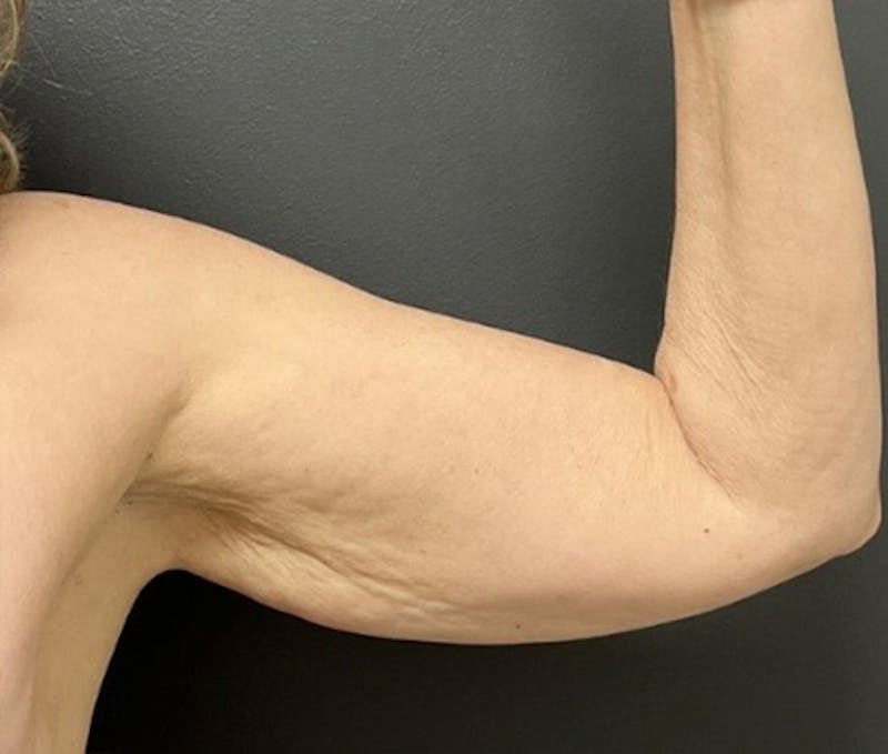 Brachioplasty (Arm Lift) Before & After Gallery - Patient 588043 - Image 3