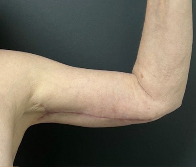 Brachioplasty (Arm Lift) Before & After Gallery - Patient 588043 - Image 4