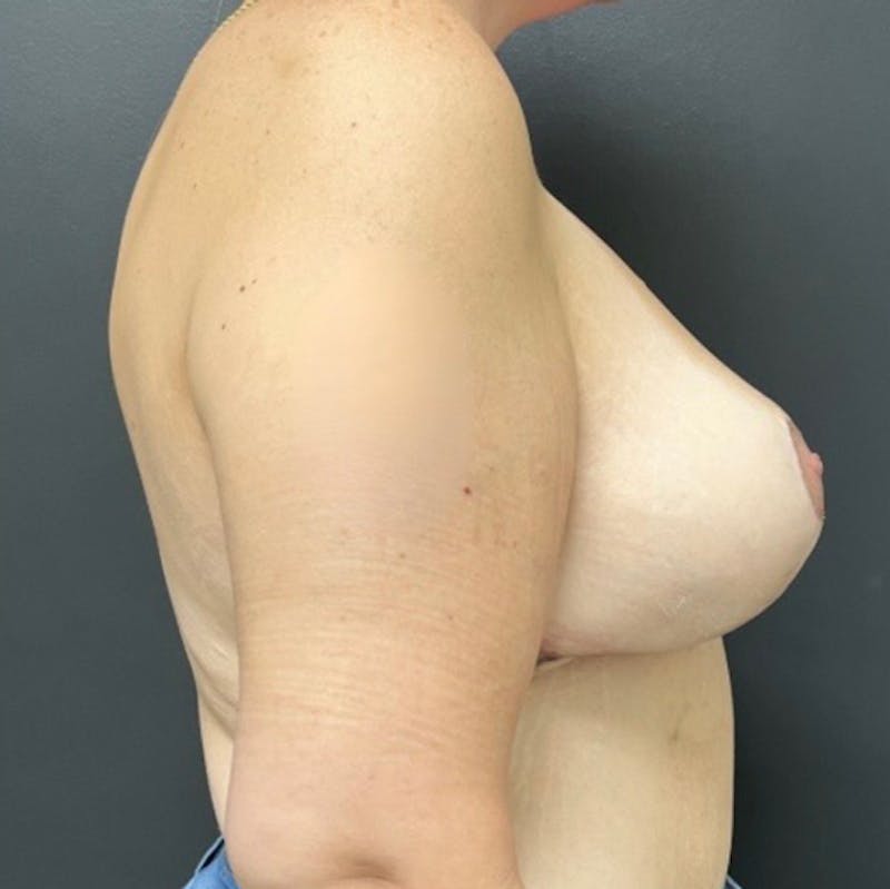 Mastopexy (Breast Lift) Before & After Gallery - Patient 301773 - Image 6