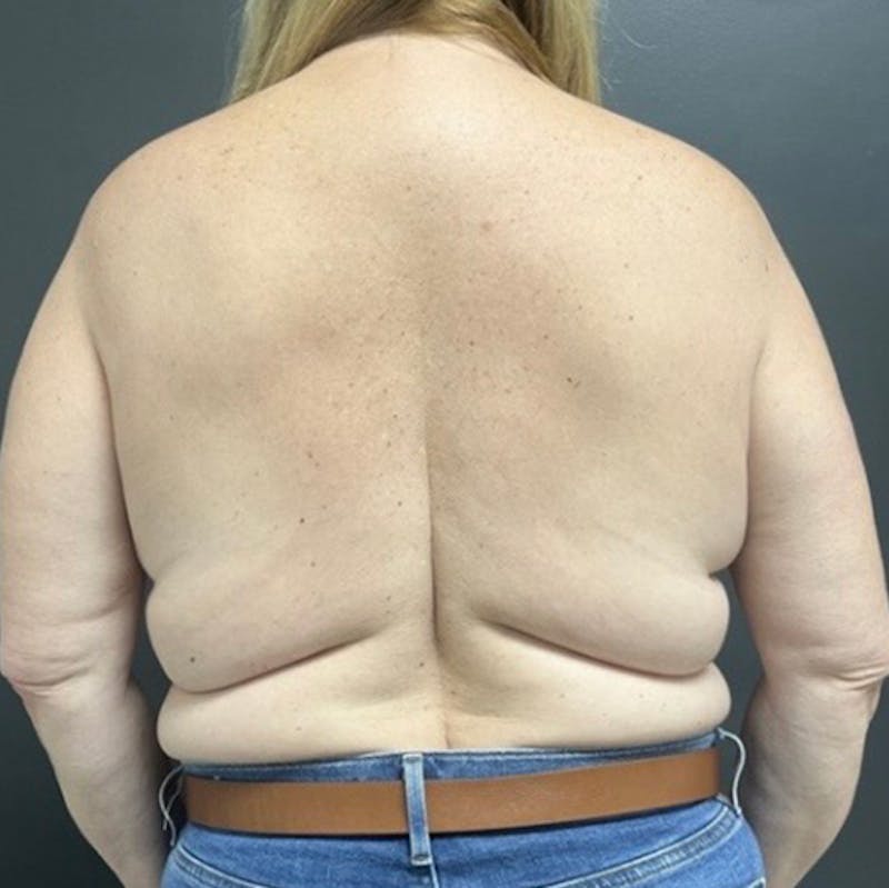 Mastopexy (Breast Lift) Before & After Gallery - Patient 301773 - Image 7