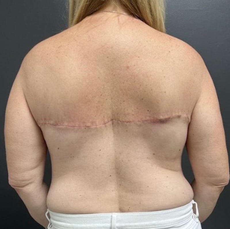 Mastopexy (Breast Lift) Before & After Gallery - Patient 301773 - Image 8
