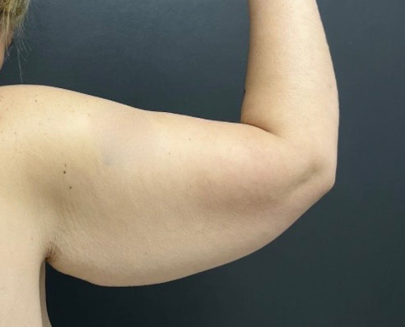 Brachioplasty (Arm Lift) Before & After Gallery - Patient 341651 - Image 3