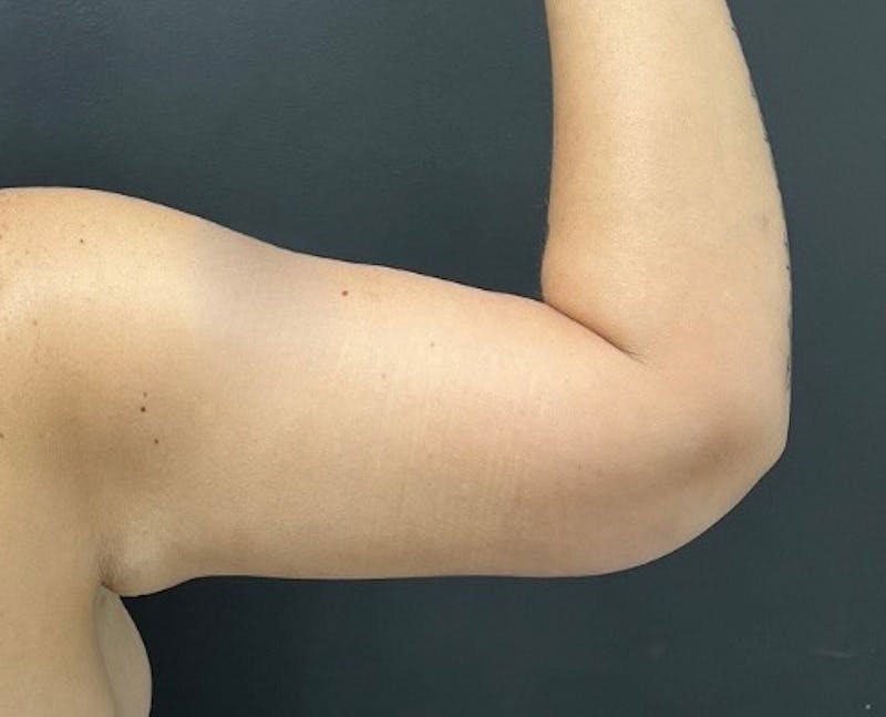 Brachioplasty (Arm Lift) Before & After Gallery - Patient 341651 - Image 4