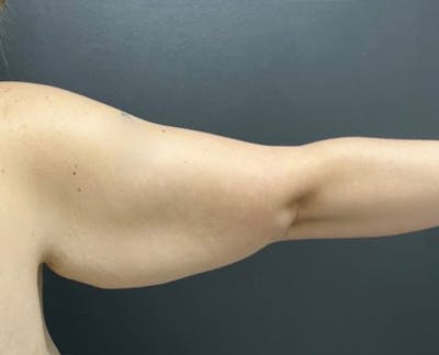 Arm Lift Before & After Gallery - Patient 341651 - Image 1