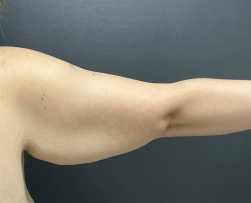 Brachioplasty (Arm Lift) Before & After Gallery - Patient 341651 - Image 1