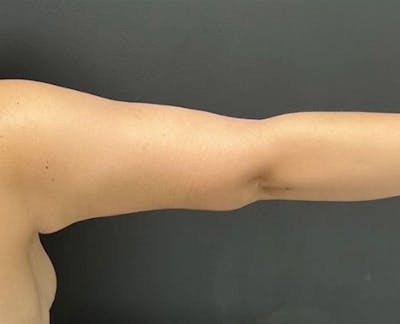 Arm Lift Before & After Gallery - Patient 341651 - Image 2