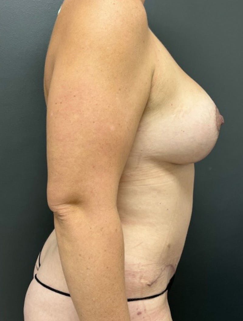 Abdominoplasty (Tummy Tuck) Before & After Gallery - Patient 117618 - Image 6