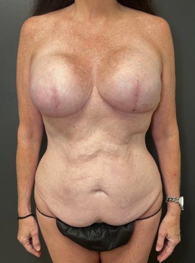 Tummy Tuck Before & After Gallery - Patient 366242 - Image 1