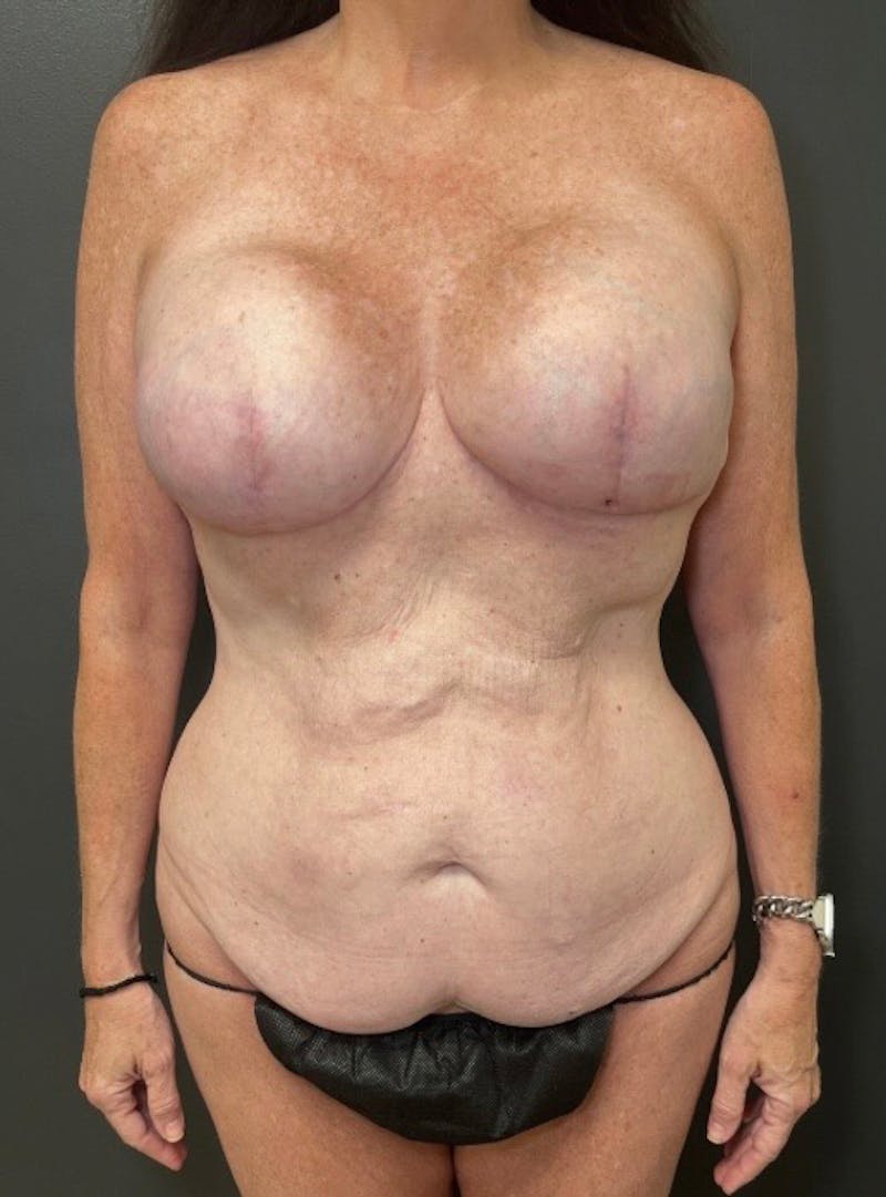 Abdominoplasty (Tummy Tuck) Before & After Gallery - Patient 366242 - Image 1