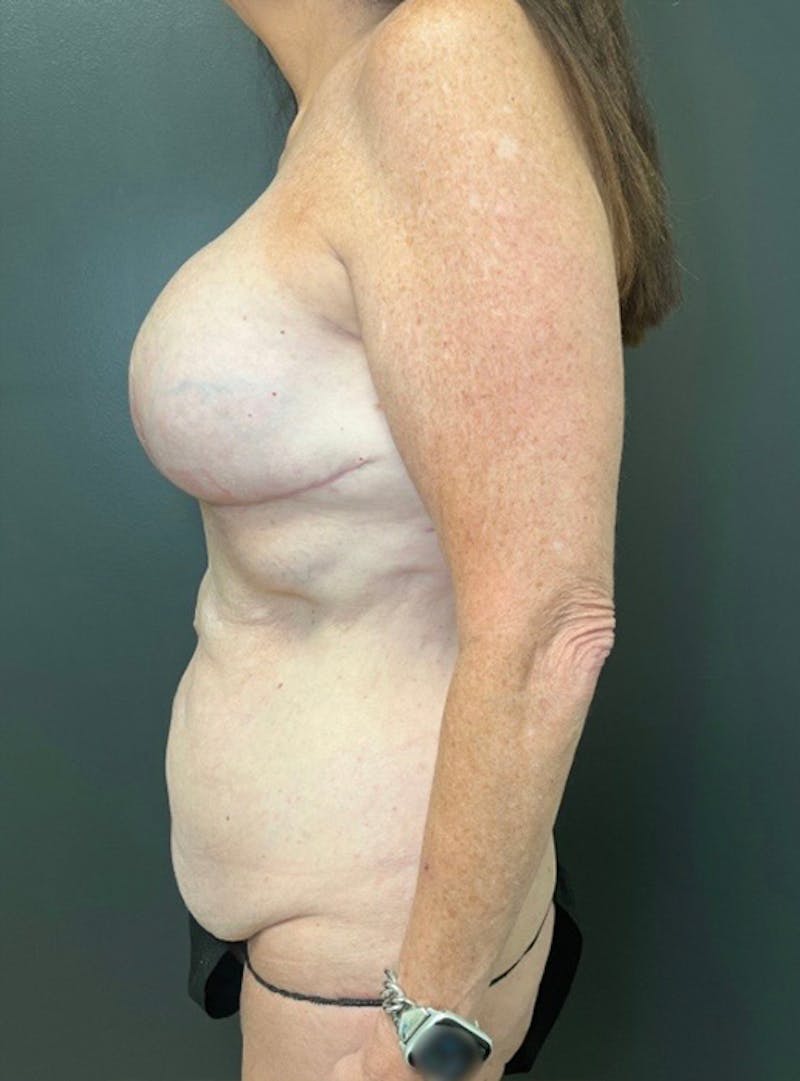 Abdominoplasty (Tummy Tuck) Before & After Gallery - Patient 366242 - Image 5