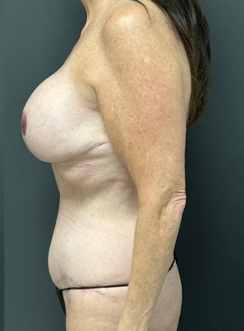 Abdominoplasty (Tummy Tuck) Before & After Gallery - Patient 366242 - Image 6